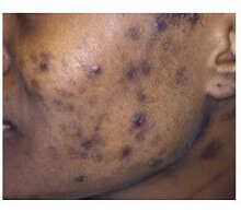 Postinflammatory Hyperpigmentation